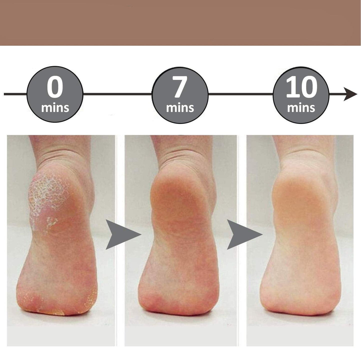 Soft Feet - Cracked Foot Callus Remover